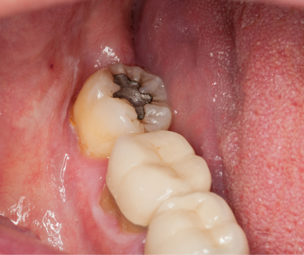4 Common Causes of Tooth Decay Tooth Spa Dentistry