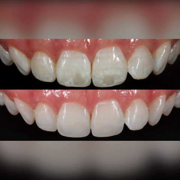 Woodstock Resin Infiltration Tooth Town Pediatric Dentistry