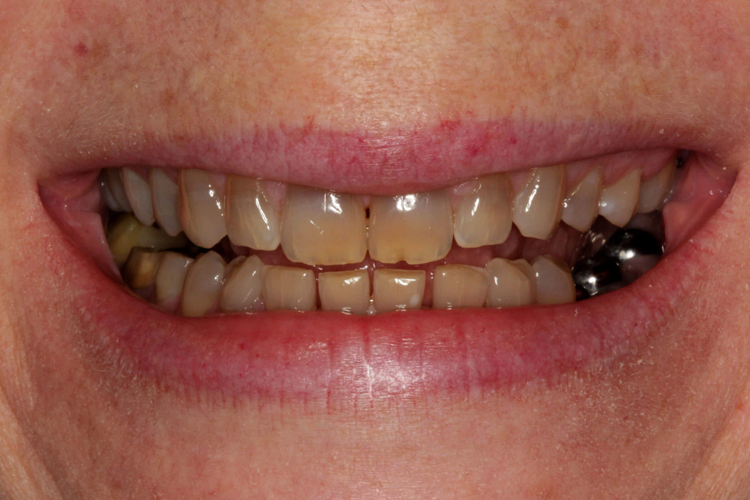 Before And After Topeka KS Dentist Topeka ProDental