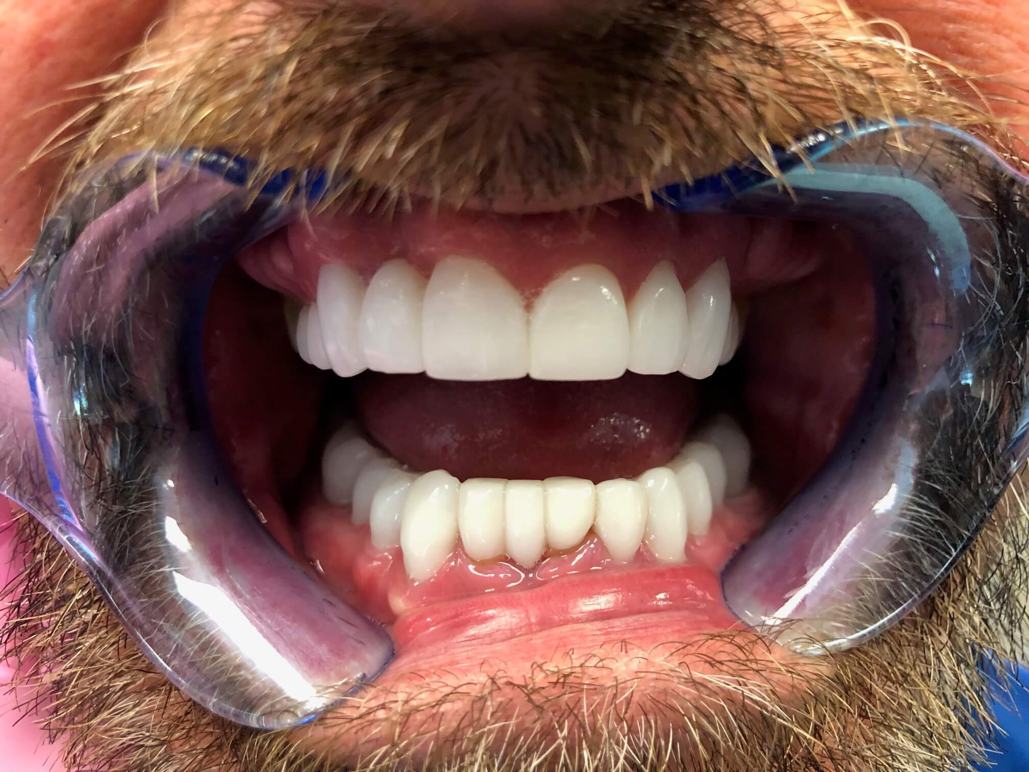 Before And After Topeka KS Dentist Topeka ProDental