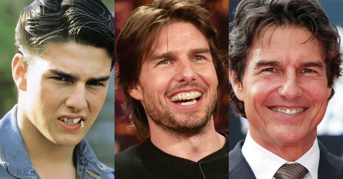 13 Celebrities with Full Dentures (With Pictures)
