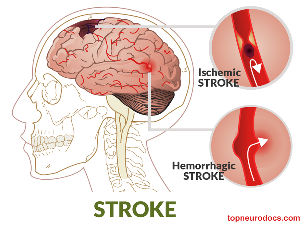 Stroke Cerebrovascular accident (CVA) Top NeuroDocs