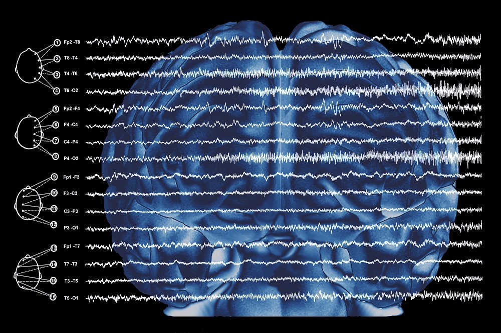 Common Errors Made in the Diagnosis and Treatment of Epilepsy Top