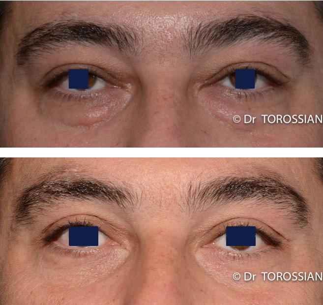 Blepharoplastie meilleur chirurgien toulouse liheathc30goldhand