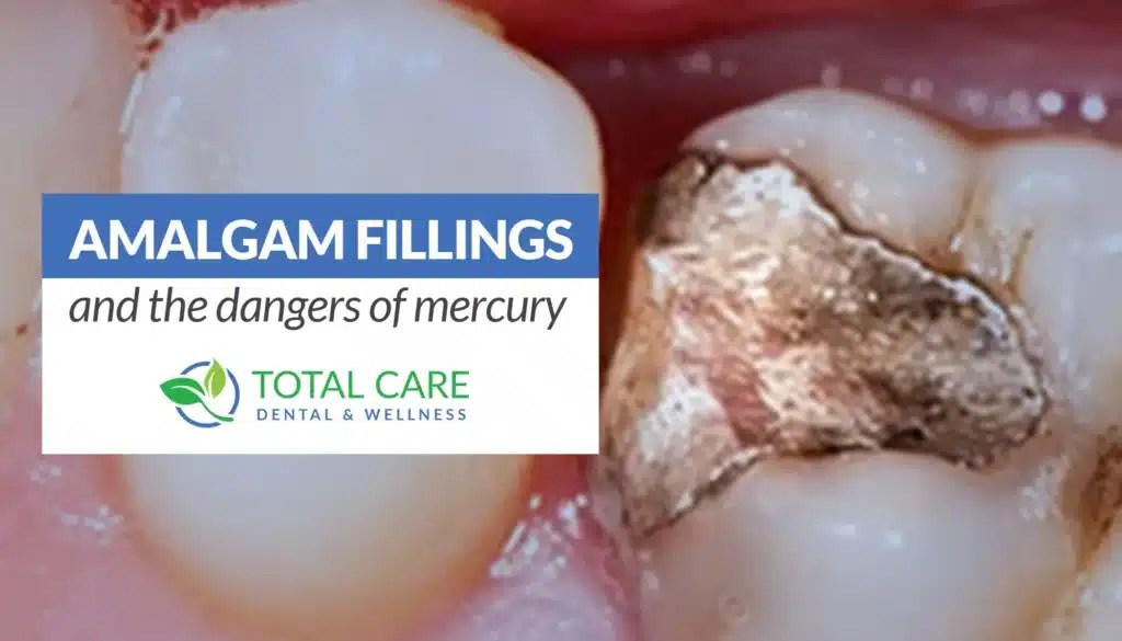 Dangers of Dental Amalgam Fillings Total Care Dental Holistic Dentistry