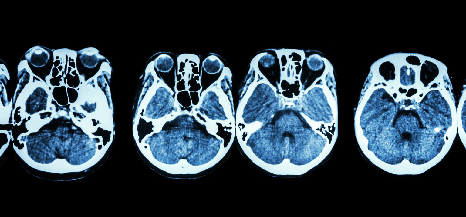 How does a sinus CT scan help to diagnose breathing problems