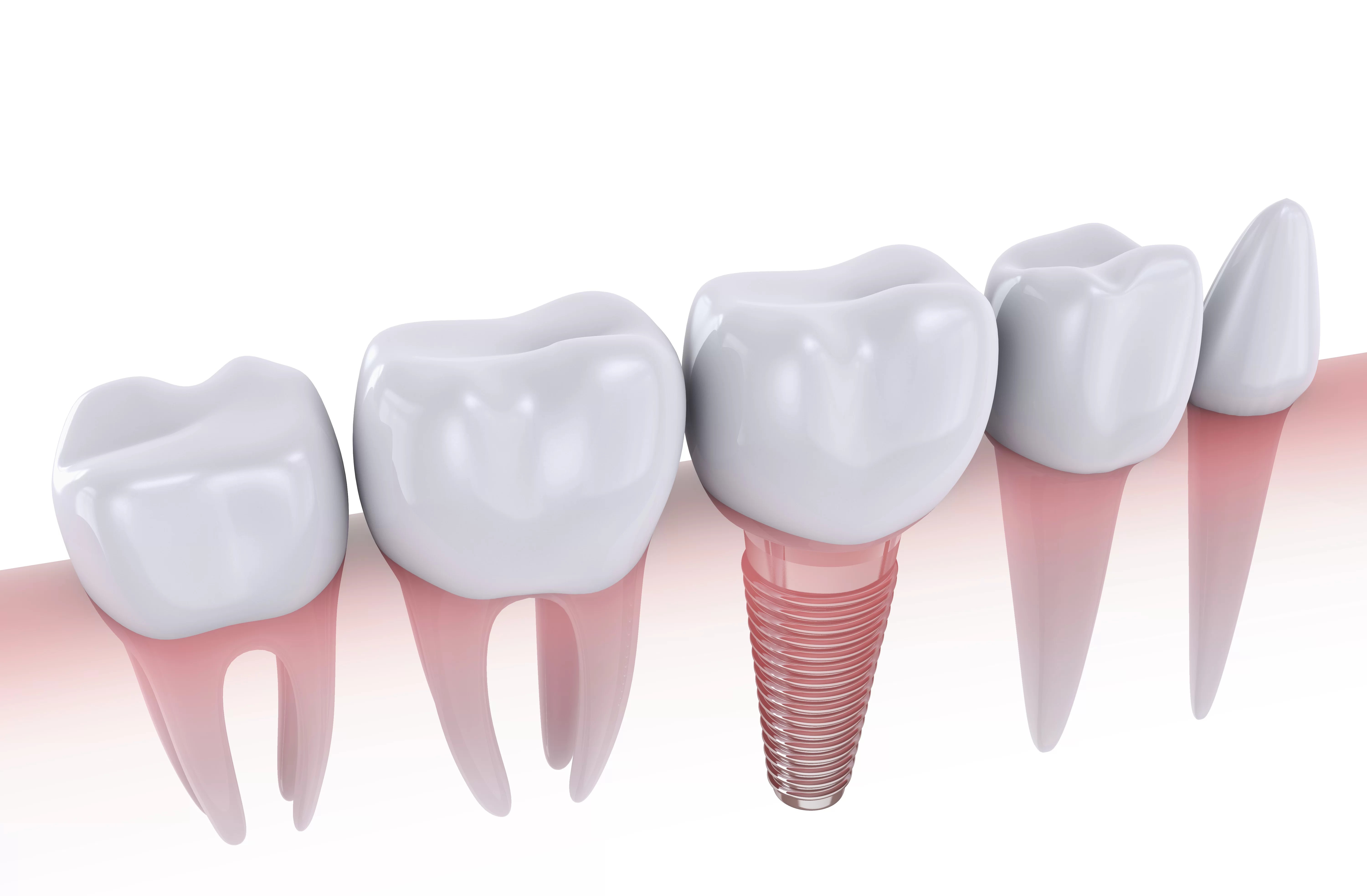 The Advantages of Getting Dental Implants Traceybell