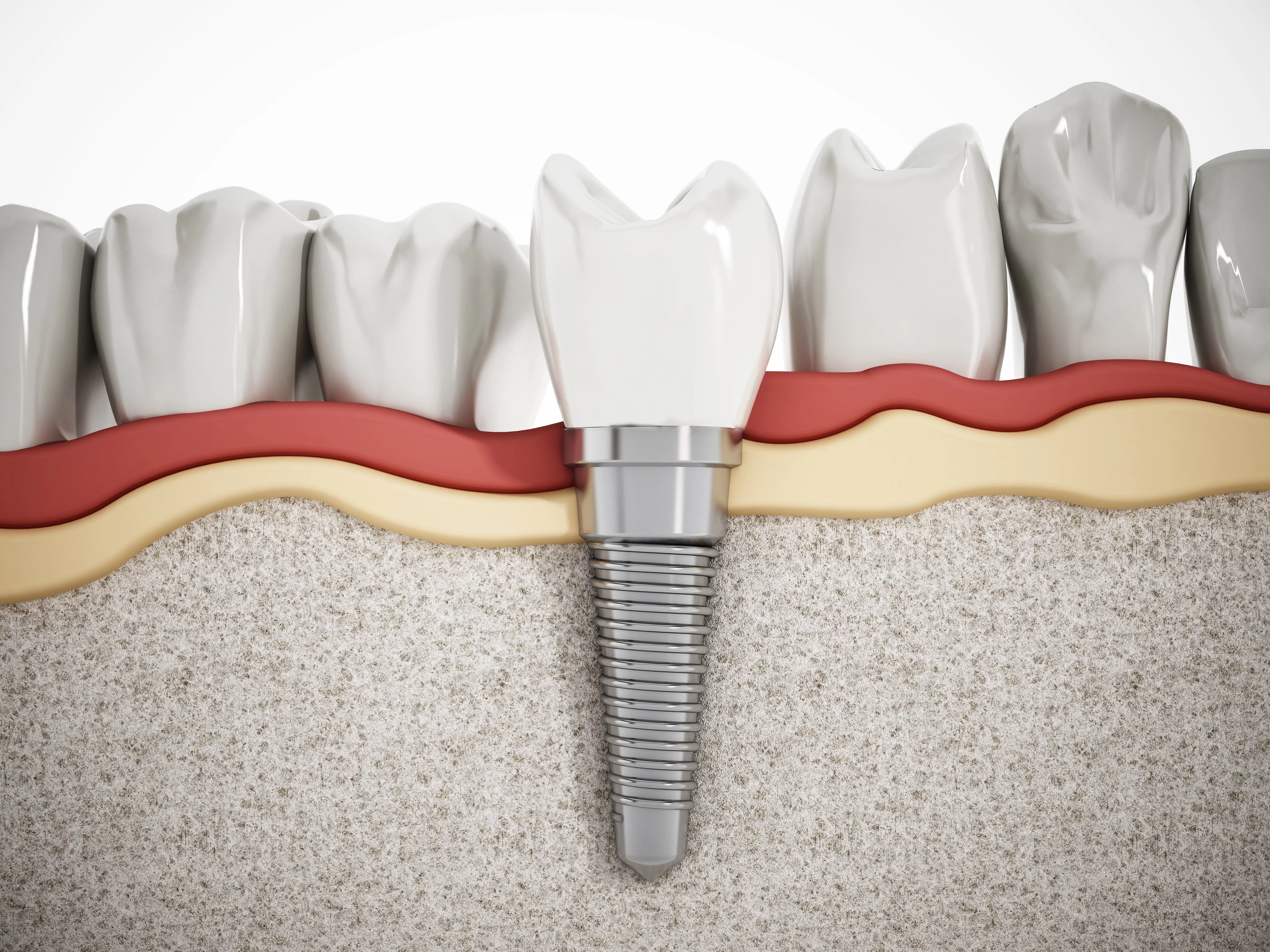 Do You Need Dental Implants? Traceybell