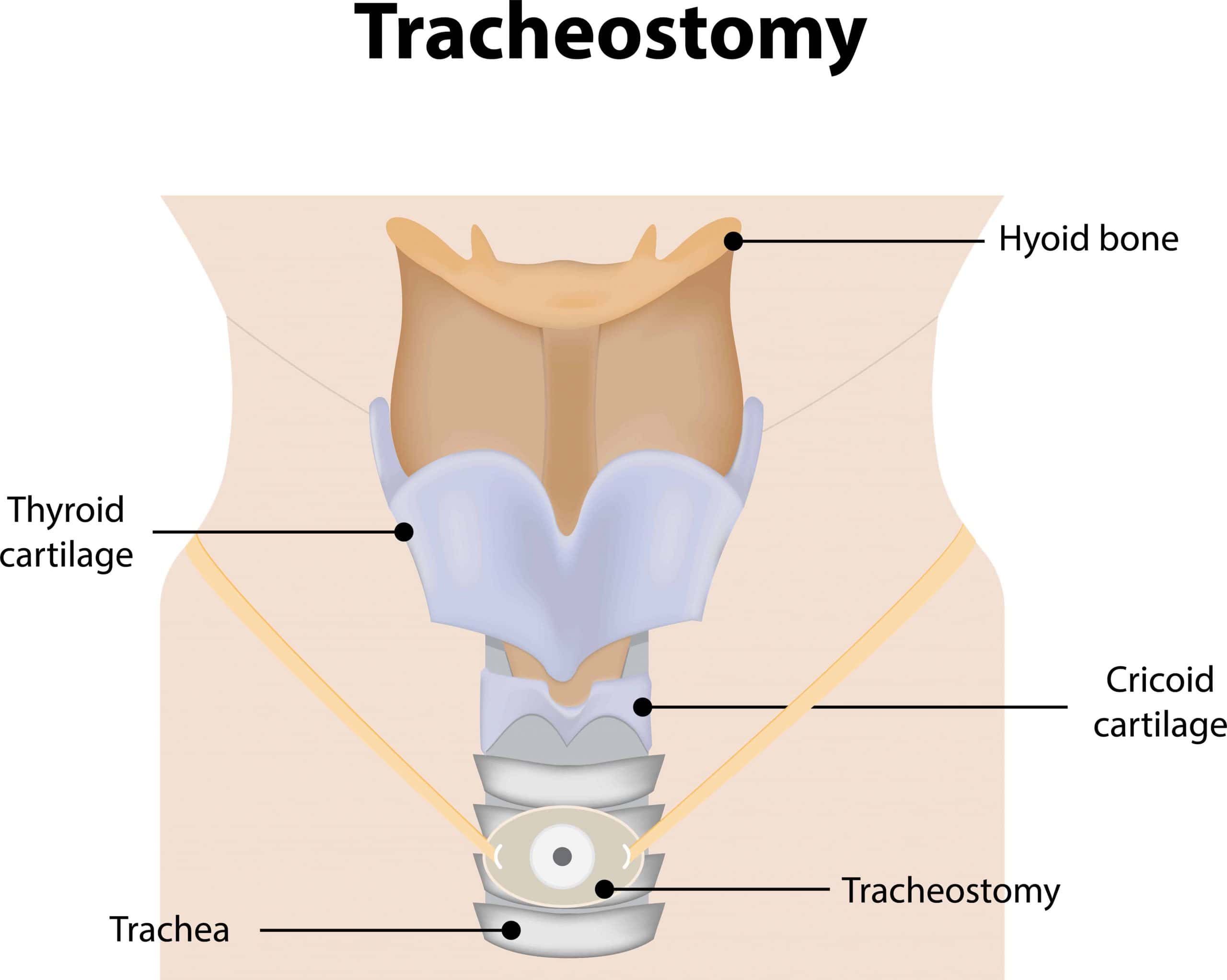 Tracheostomy Essentials Tracheostomy Education