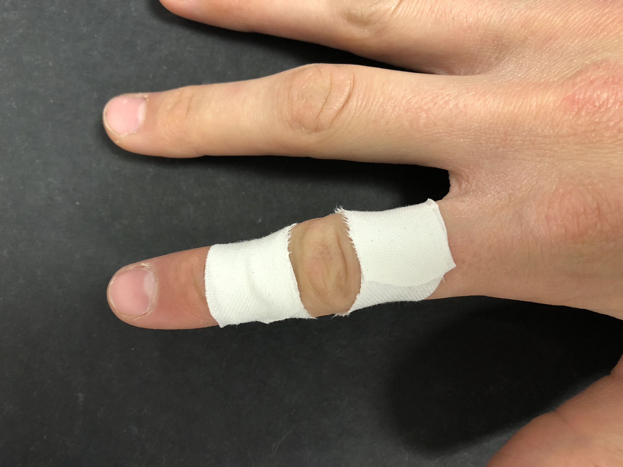 Rock Climbing Injuries