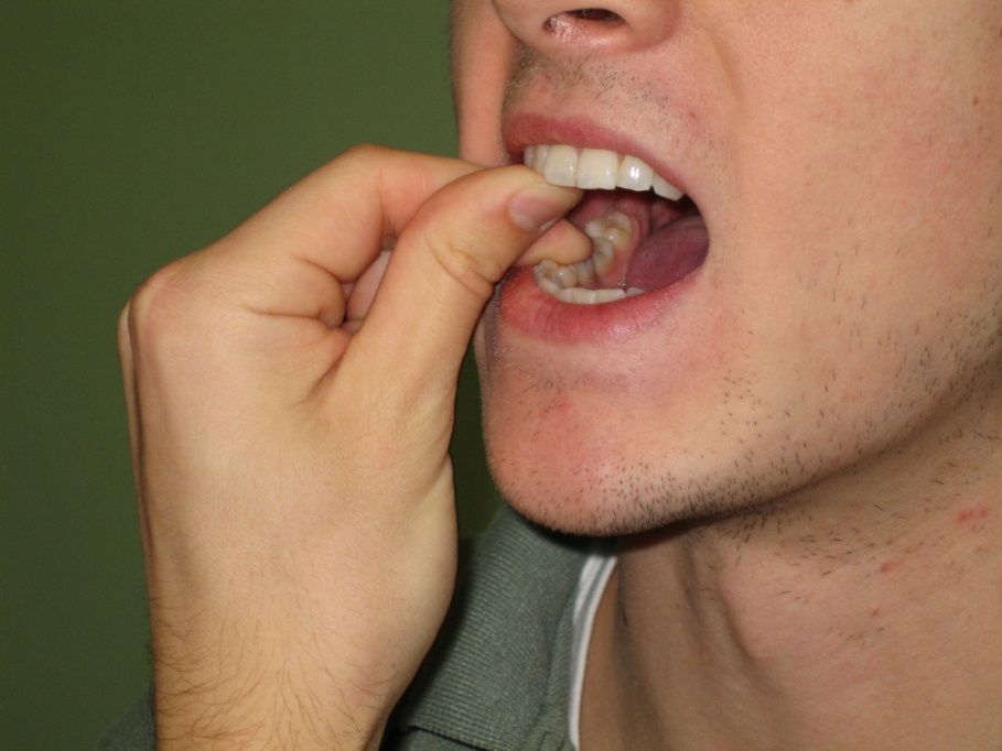 What is Trismus? And how best is it treated? Treating TMJ