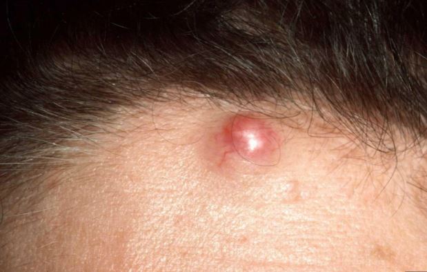 Cyst on Forehead Causes, Symptoms, Pictures, Sebaceous Cyst, White