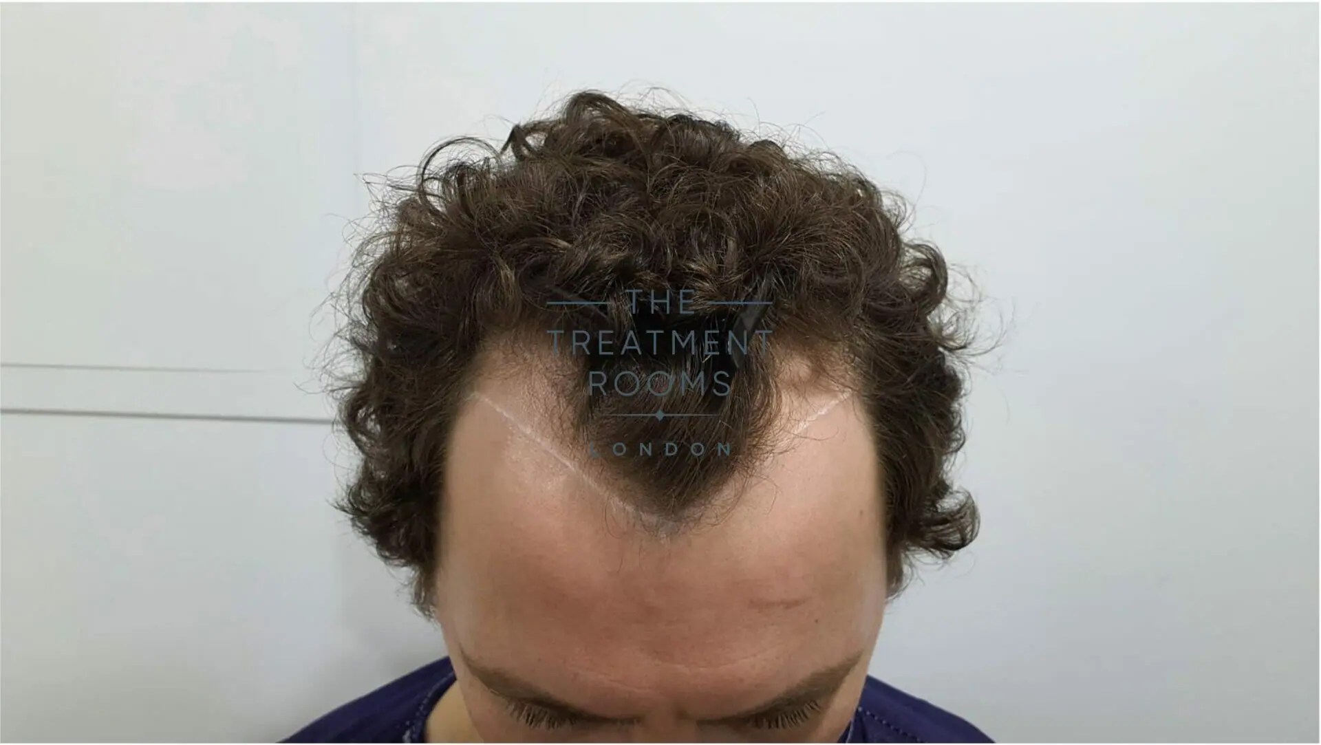 How Much Does A Widow's Peak Hair Transplant Cost? Hair Transplant