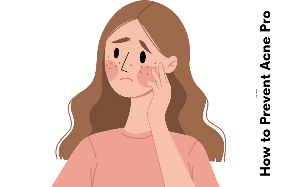 How to Prevent Acne Like a Pro Expert Tips and Tricks 2023