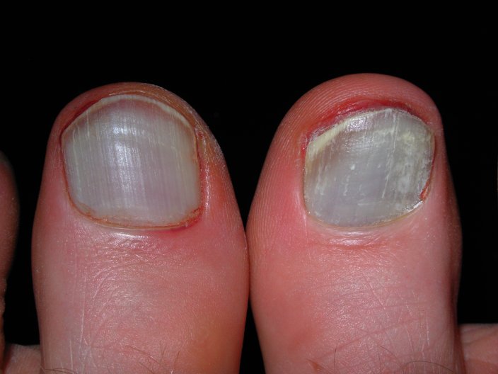 Blood blisters below the big toe nails.