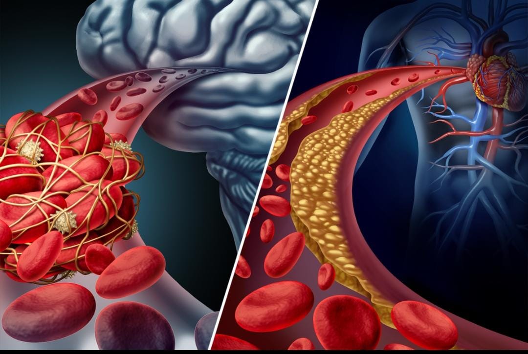 The Difference Between a Stroke and a Heart Attack