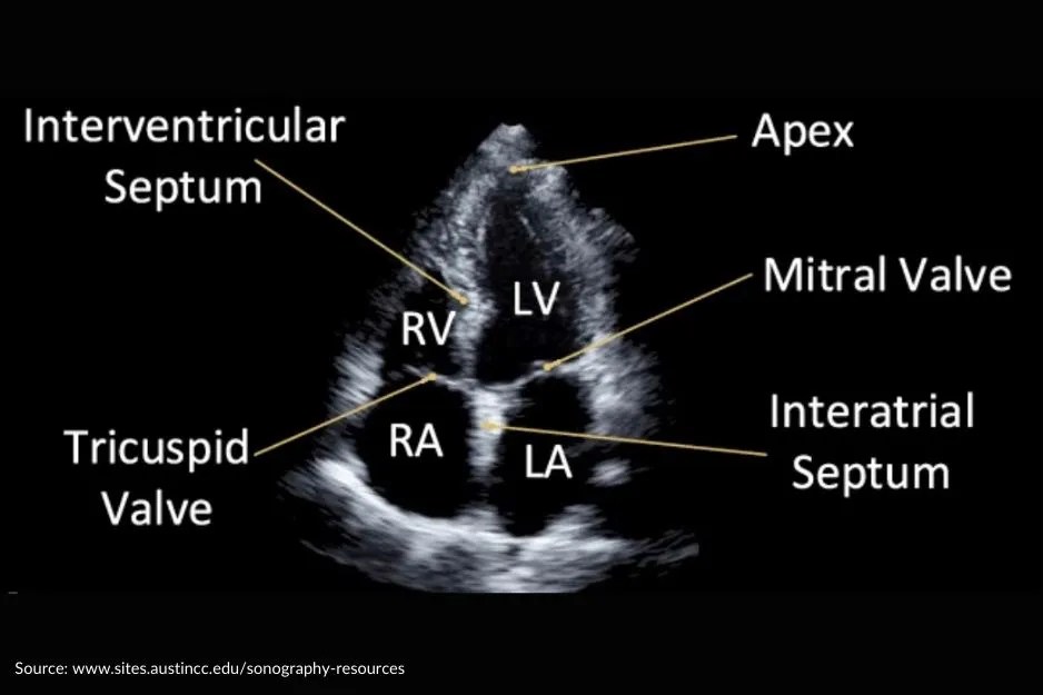Interpreting Echocardiogram Results A Comprehensive Guide for
