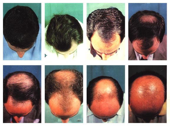 Informazioni e definizione dell'alopecia