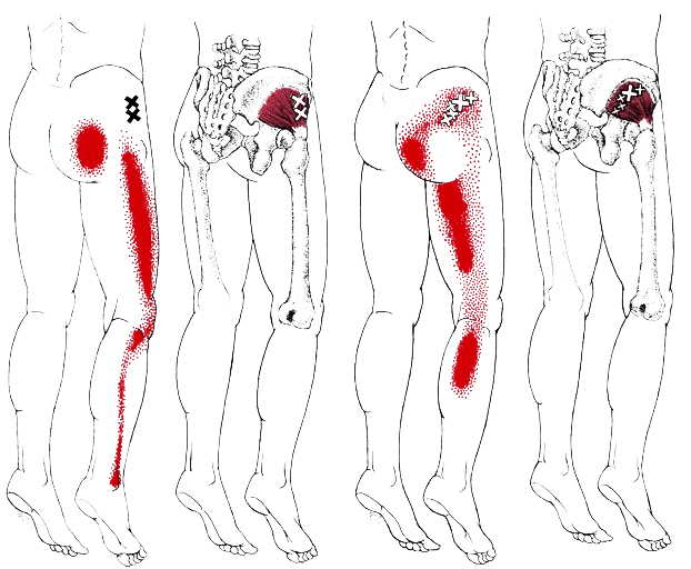 Trigger Point Massage OC Service Trigger Point Massage OC