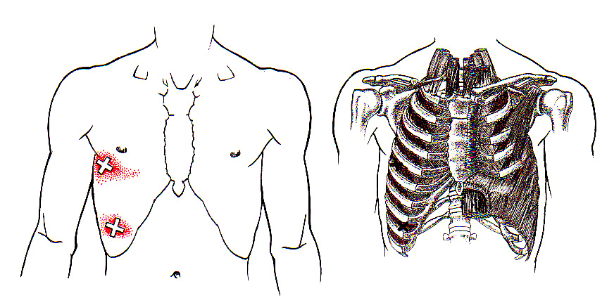 A doctor will need to talk through your symptoms with you in order to identify the cause of your pain, as your rib cage comprises of the ribs themselves and muscles that hold the ribs together, both of which are possible sources of pain. Intercostals The Trigger Point Referred Pain Guide