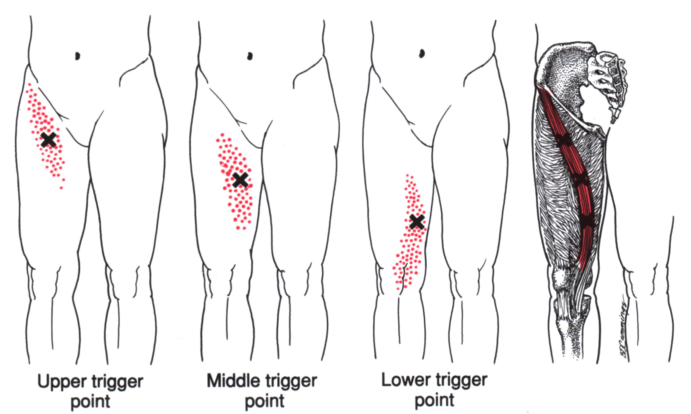 Sartorius The Trigger Point & Referred Pain Guide