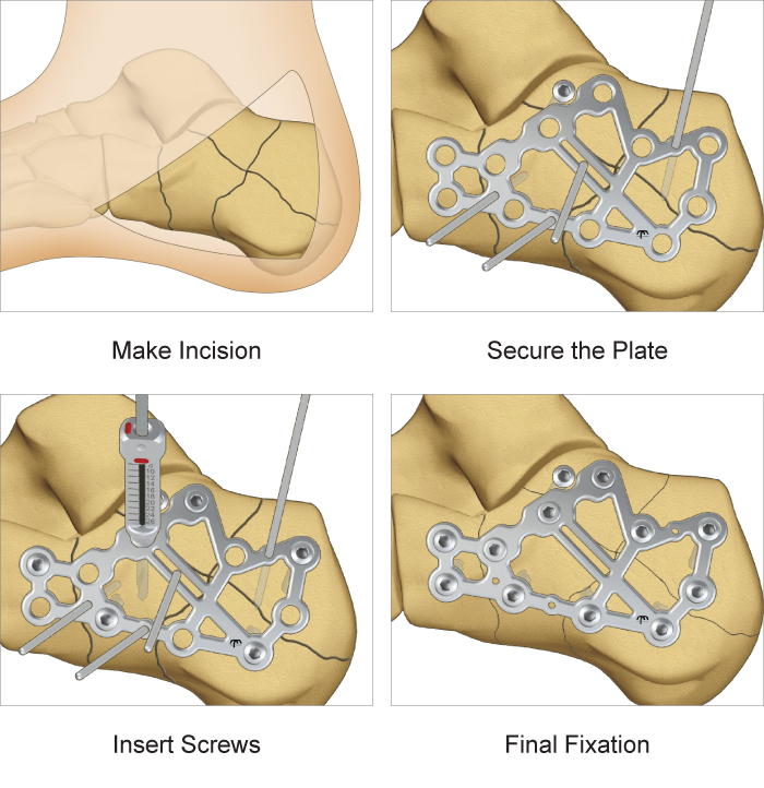 Calcaneal Perimeter Plate Lower Extremity Fixation TriMed Inc.