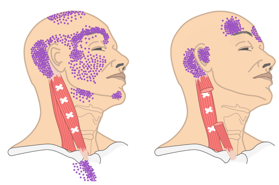 Cervicogene Hoofdpijn | Kinesist Berchem (Antwerpen)