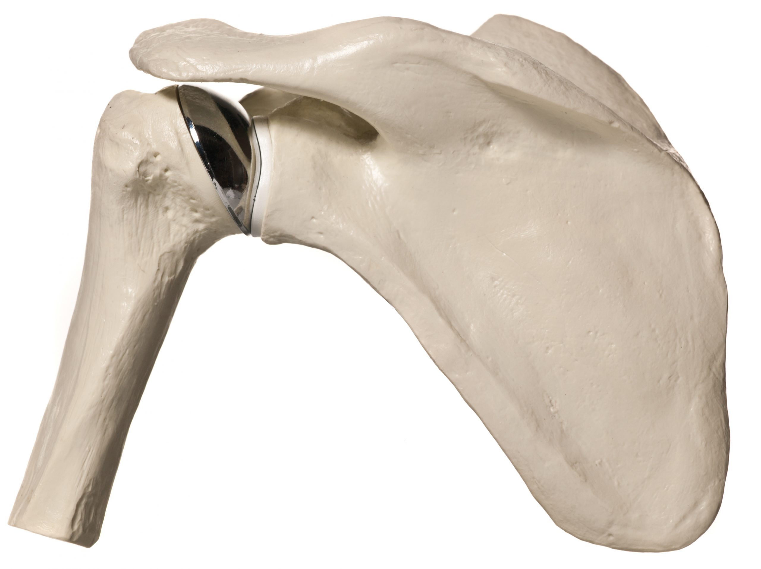 Shoulder Replacement Surgery San Antonio TSAOG Orthopedics