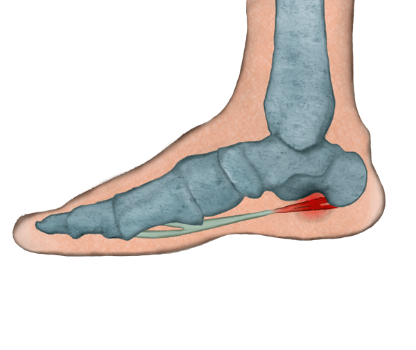 Fascitis plantar Causas, Síntomas y Tratamiento
