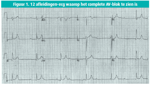 Congenitaal Totaal Atrioventriculair Blok | Tijdschrift Voor Cardiologie