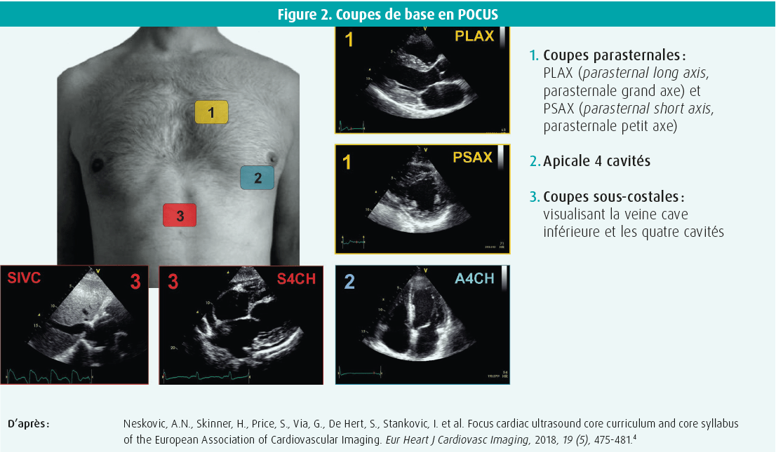 L'écho(cardio)graphie au chevet du patient en soins aigus Journal de