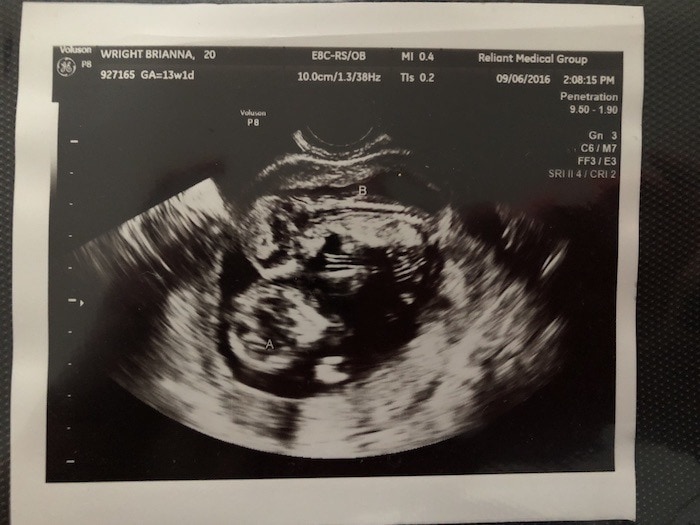 13 Weeks Pregnant with Twins Tips, Advice & How to Prep Twiniversity