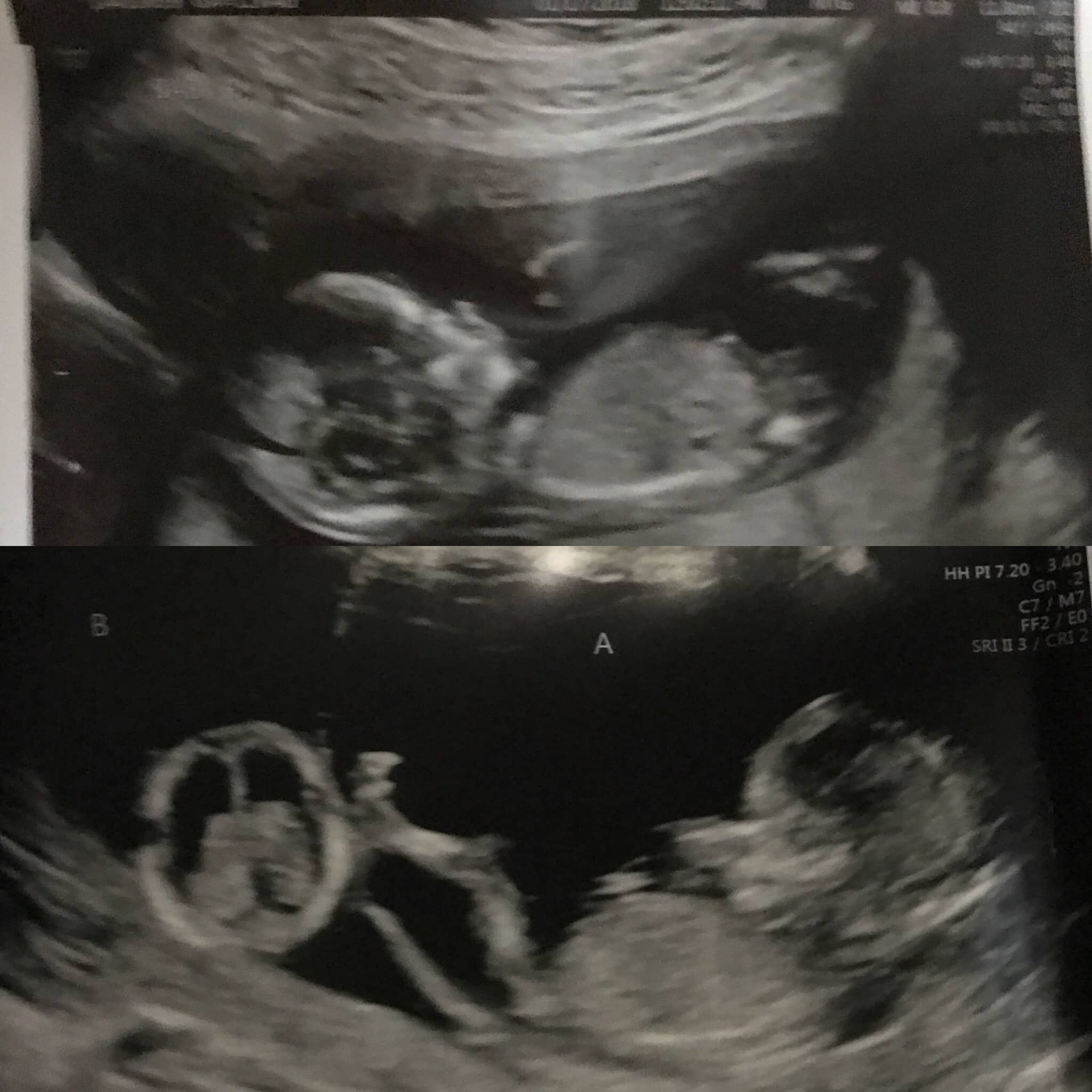 14 Weeks Pregnant with Twins Tips, Advice & How to Prep Twiniversity