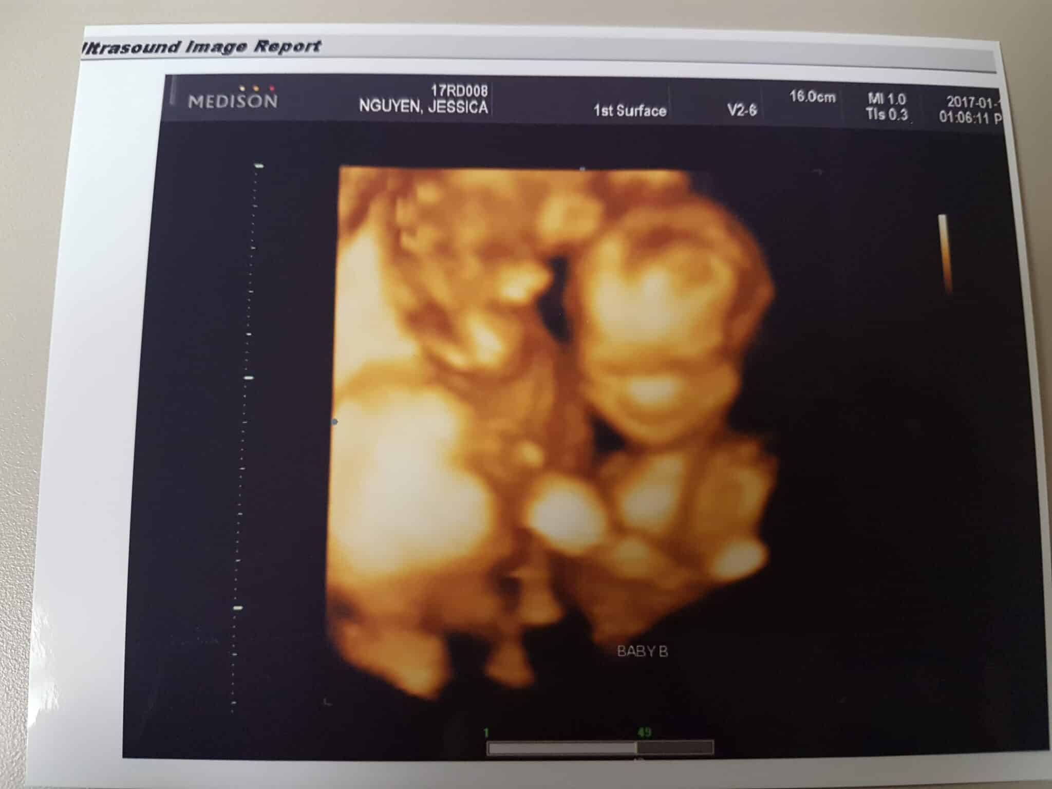 18 Weeks Pregnant with Twins Tips, Advice &amp, How to Prep Twiniversity