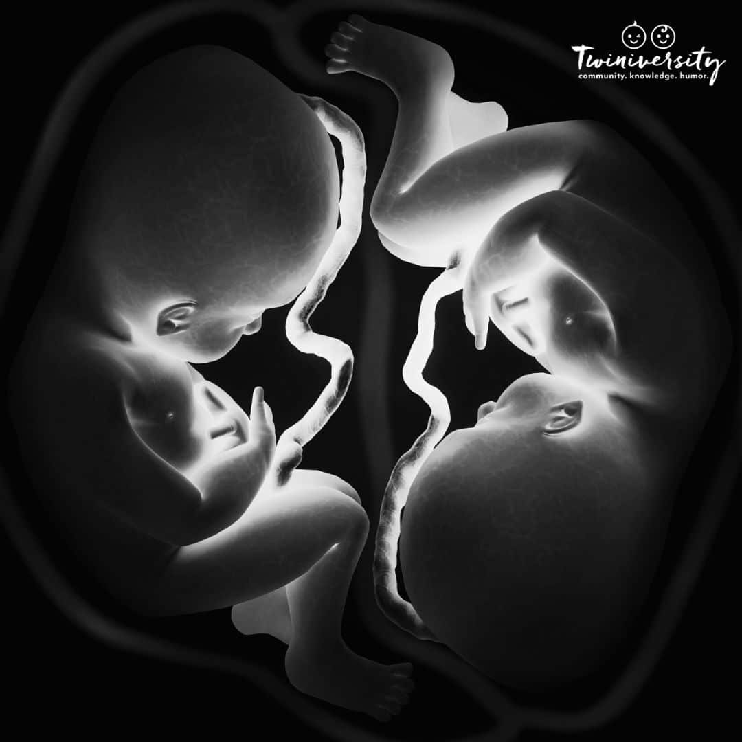 Placenta Position Not all are the Same Twiniversity 1 Parenting