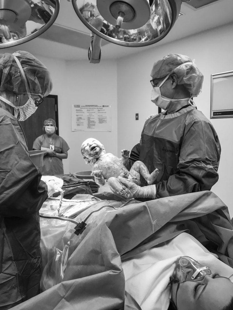 My Emergency Csection Delivery with Twins Twiniversity