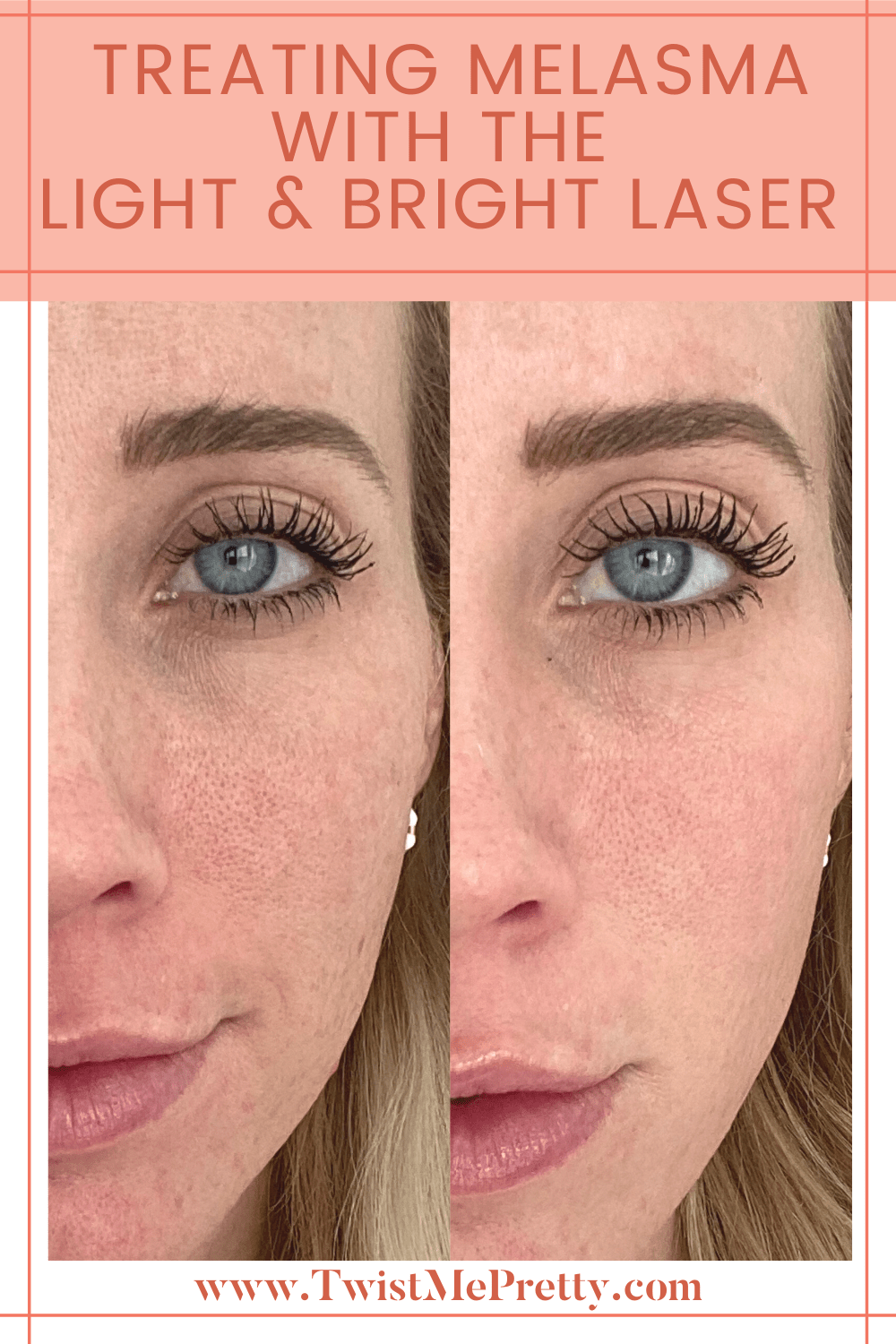 Treating Melasma with The Light and Bright Laser Twist Me Pretty