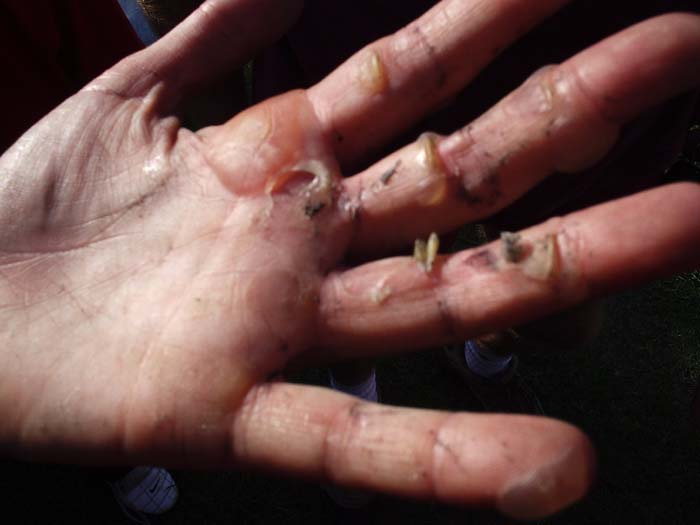 Rowing Blisters 101 Ready all, row…