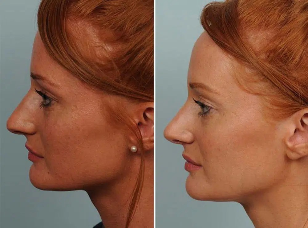 Une meilleure connaissance de la rhinoplastie, la