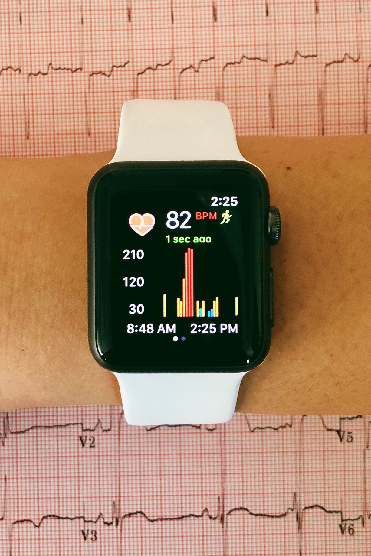 Smartwatch Effective in Detecting Atrial Fibrillation UC San Francisco