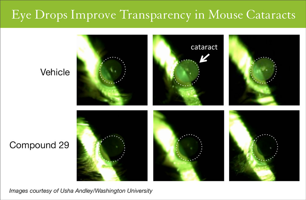Eye Drops Could Clear Up Cataracts Using Newly Identified Chemical UC