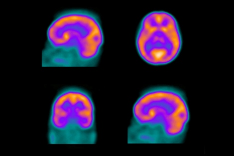 Distinguishing Between Dementia And Depression With Neuroimaging