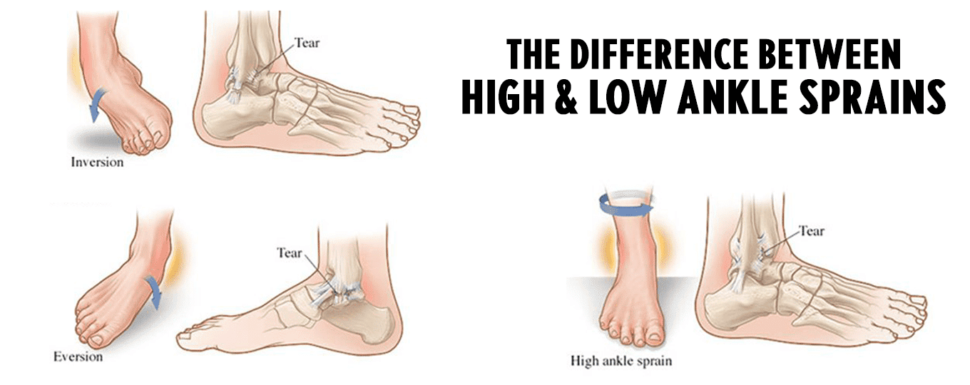 High Ankle Sprain Vs Ankle Sprain Whats The Difference Images and