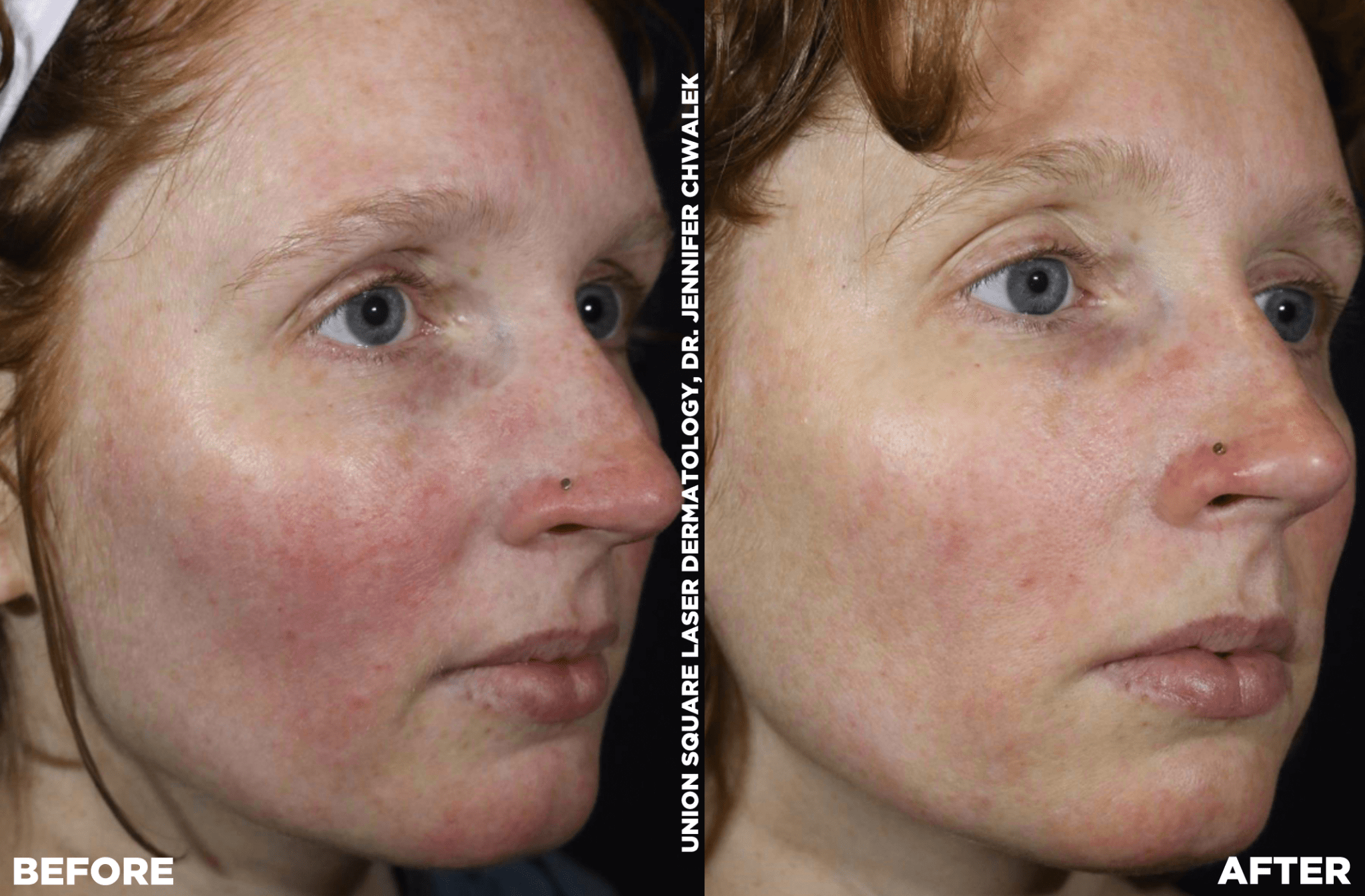 Skin Resurfacing Lasers & Devices Archives UnionDerm The Art