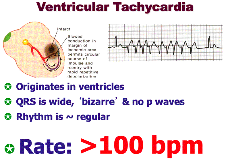 Ventricular rhythms