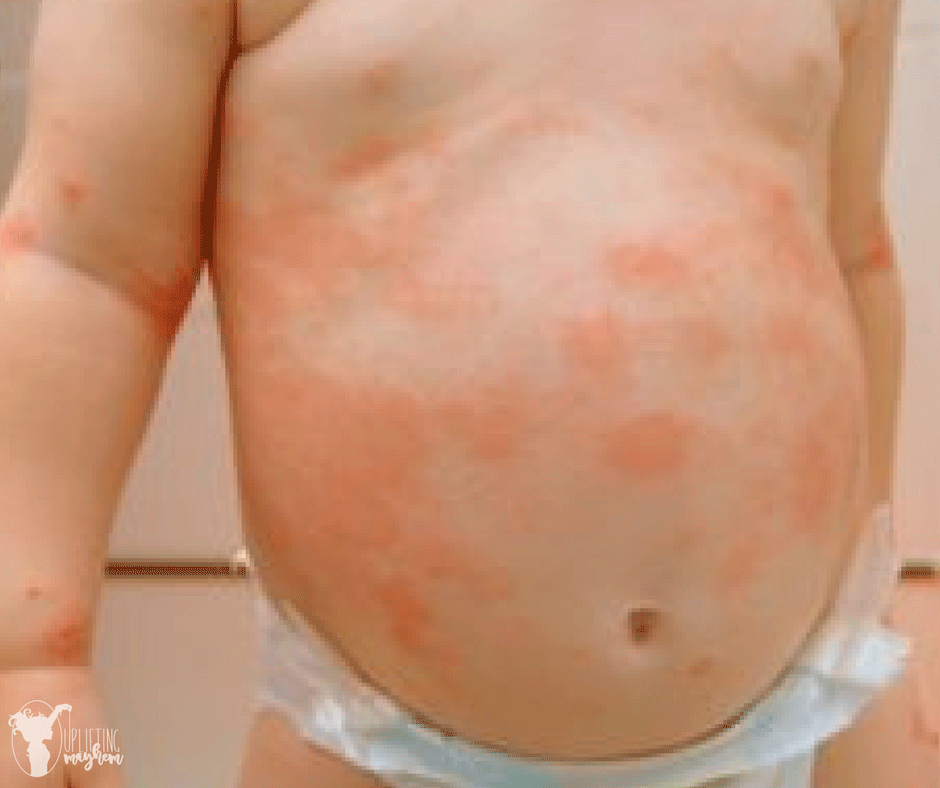 The Lessthan10 Eczema Solution I Found on Accident for my Baby