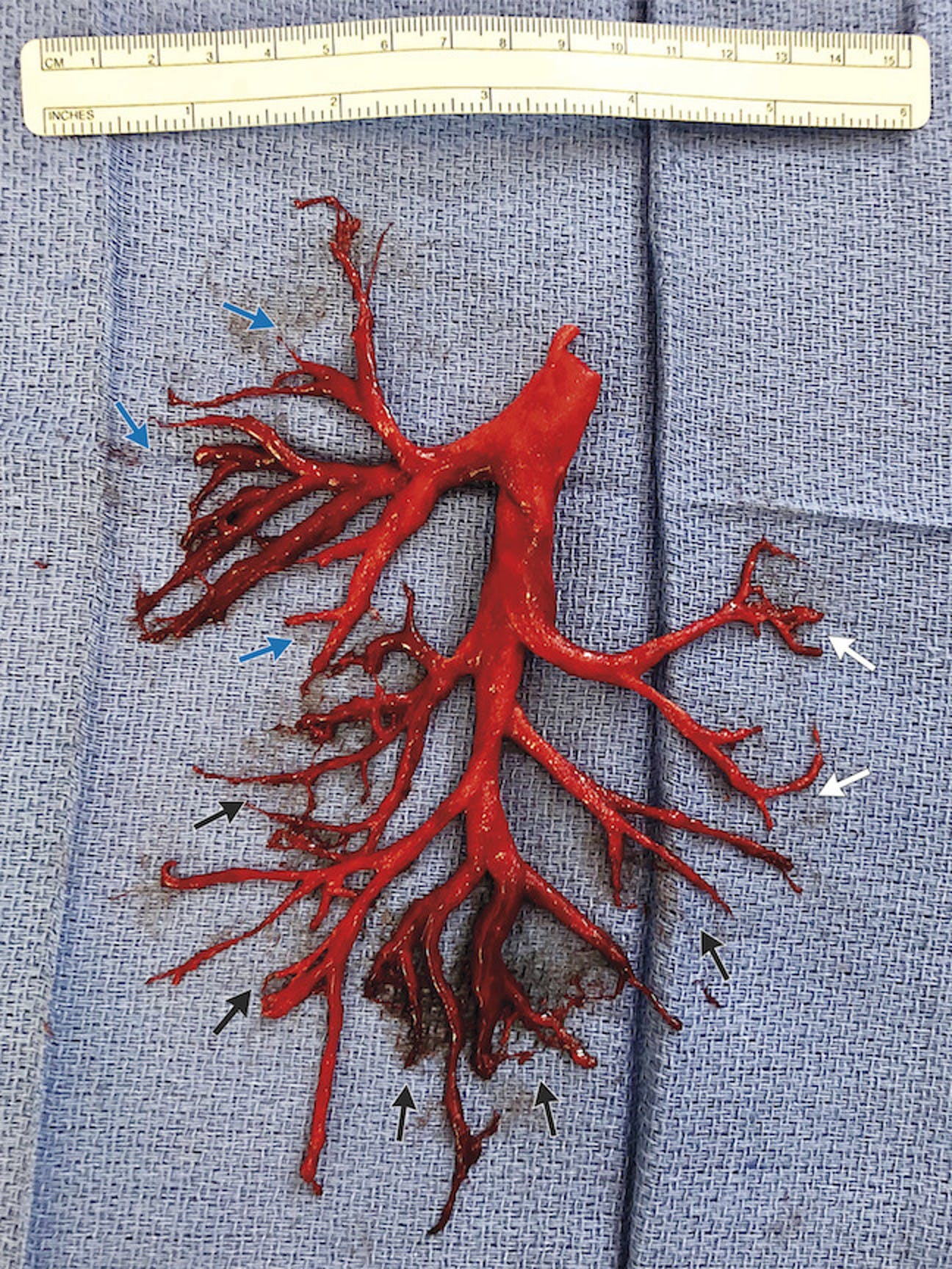 Shocking Blood Clot Takes on the Appearance of a Man's Lung