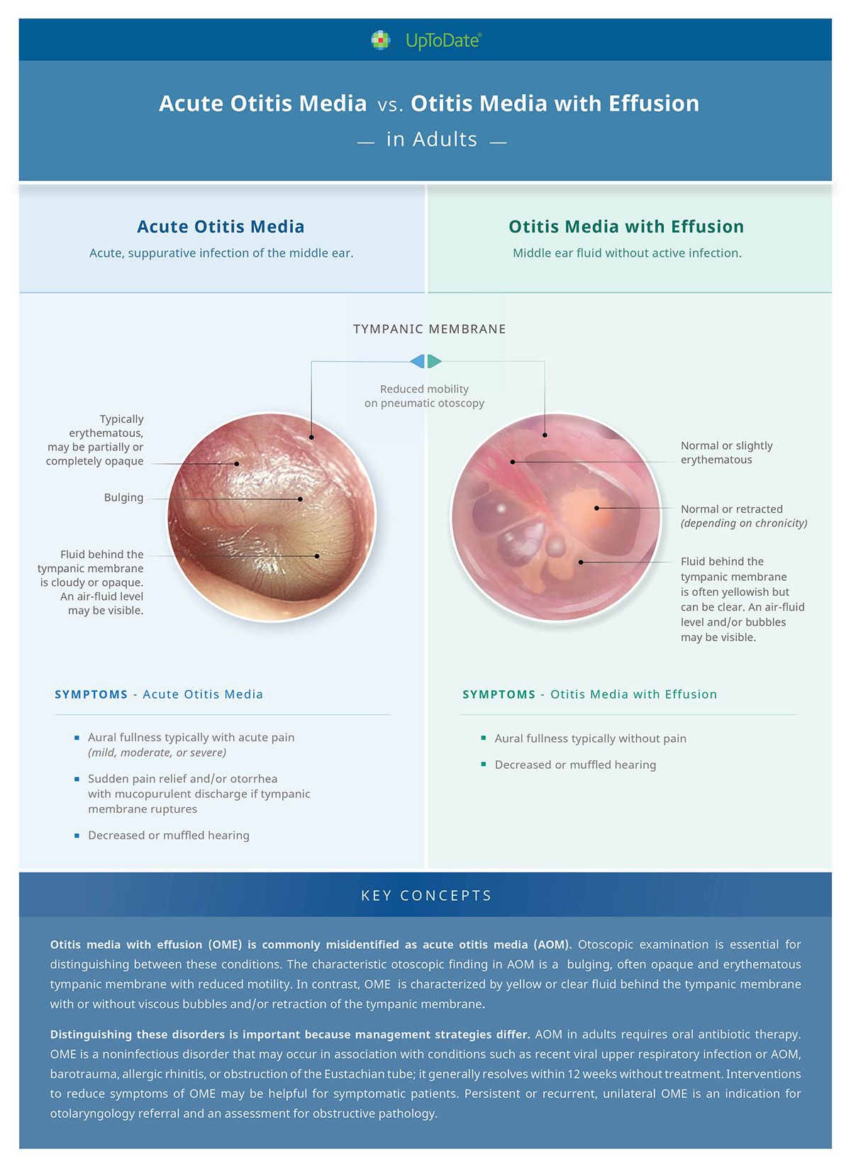 Normal Tympanic Membrane Vs Otitis Media at Carmen Decker blog