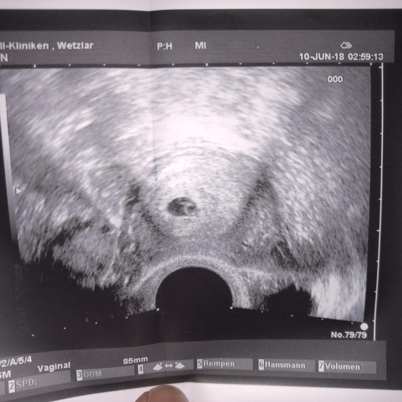 8+1 ssw Ultraschall, ramzi Theorie ? Forum Mädchen oder Junge? urbia.de