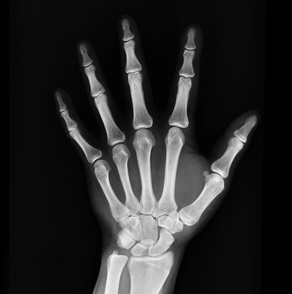 Does Low Sodium Cause Weak Bones? UreaAide™